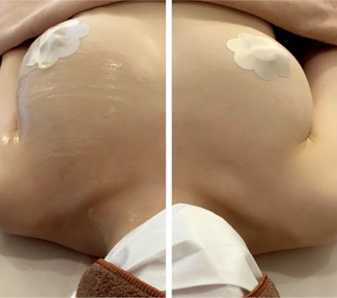 NR機器効果写真