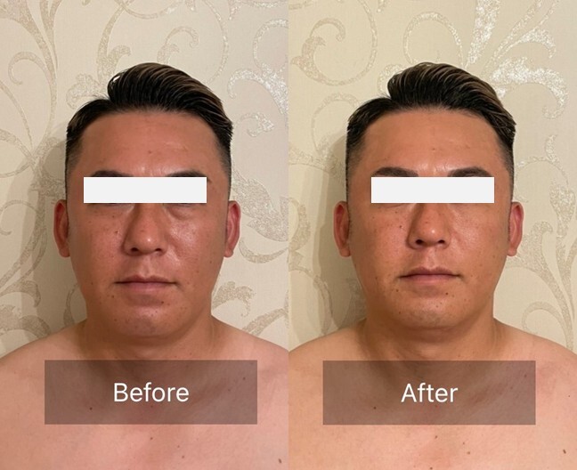 NR機器効果写真